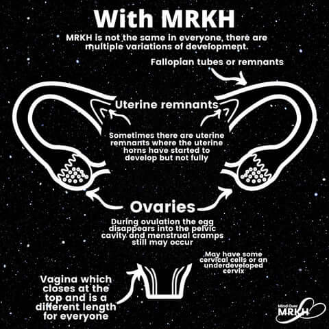 What Is MRKH?